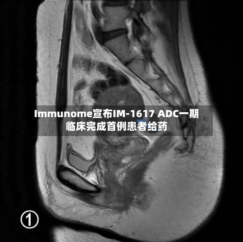 Immunome宣布IM-1617 ADC一期临床完成首例患者给药