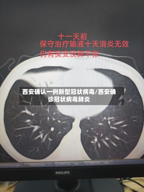 西安确认一例新型冠状病毒/西安确诊冠状病毒肺炎