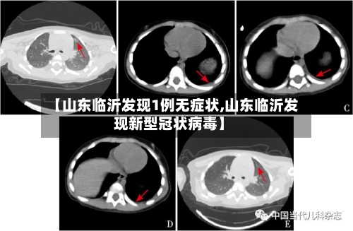【山东临沂发现1例无症状,山东临沂发现新型冠状病毒】-第2张图片