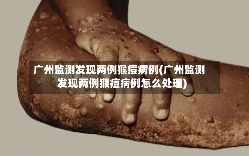 广州监测发现两例猴痘病例(广州监测发现两例猴痘病例怎么处理)