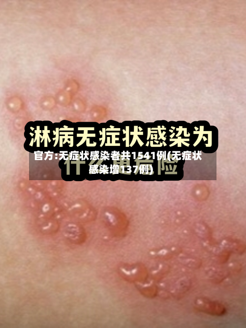 官方:无症状感染者共1541例(无症状感染增137例)
