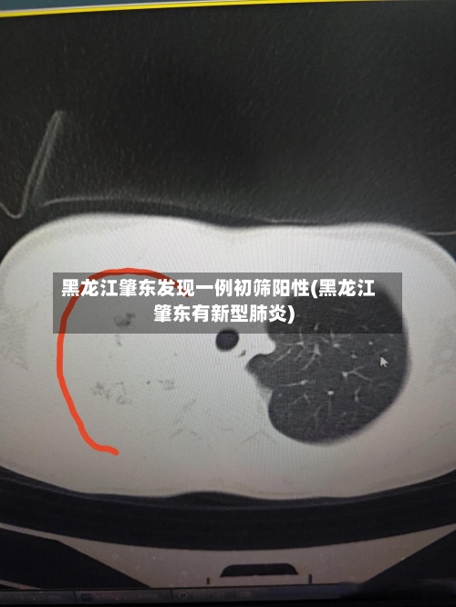 黑龙江肇东发现一例初筛阳性(黑龙江肇东有新型肺炎)-第3张图片