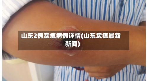 山东2例炭疽病例详情(山东炭疽最新新闻)-第3张图片
