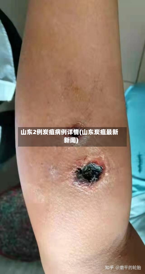 山东2例炭疽病例详情(山东炭疽最新新闻)
