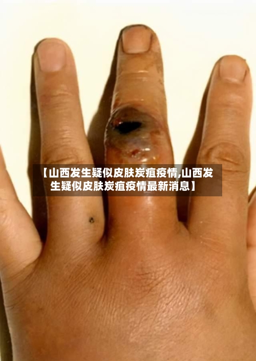 【山西发生疑似皮肤炭疽疫情,山西发生疑似皮肤炭疽疫情最新消息】