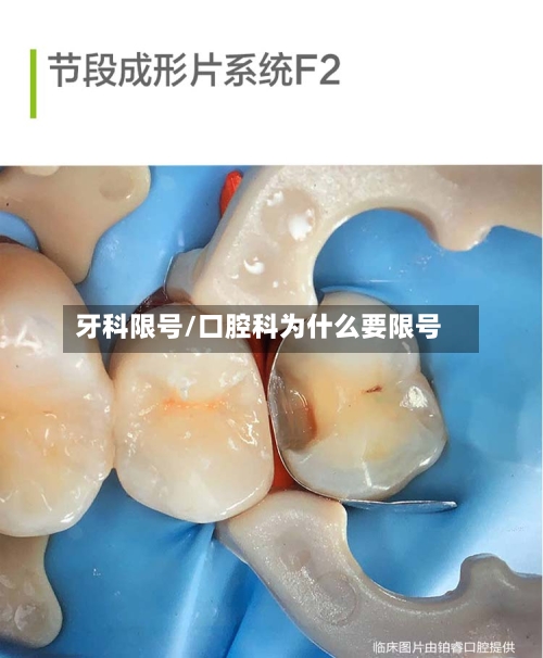 牙科限号/口腔科为什么要限号-第3张图片