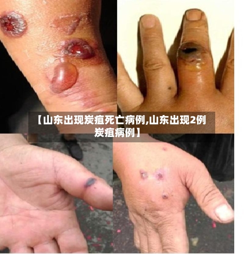 【山东出现炭疽死亡病例,山东出现2例炭疽病例】
