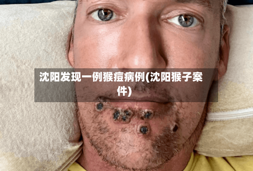 沈阳发现一例猴痘病例(沈阳猴子案件)-第2张图片
