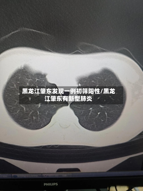 黑龙江肇东发现一例初筛阳性/黑龙江肇东有新型肺炎