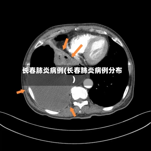 长春肺炎病例(长春肺炎病例分布)