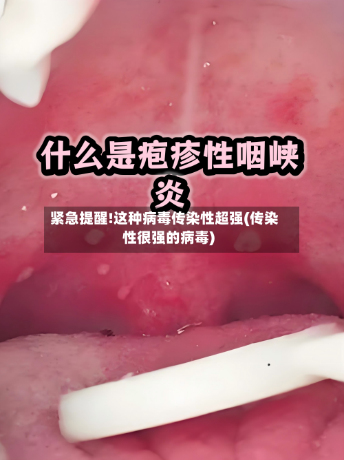 紧急提醒!这种病毒传染性超强(传染性很强的病毒)