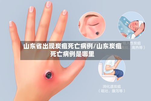 山东省出现炭疽死亡病例/山东炭疽死亡病例是哪里
